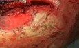 Tropfen für Tropfen Anwendung von Glubran 2 als Abdichtungsmittel in der plastischen Duralchirurgie