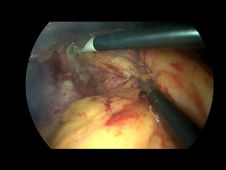Subtotale Gastrektomie bei großem Fundus GIST mit Hämostase-Splenektomie