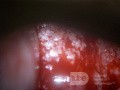 Zervikales Adenokarzinom (Carcinoma glandulare colli uteri)
