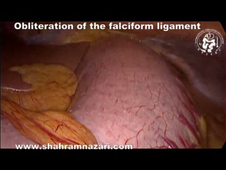 Obliteration des Ligamentum falciforme
