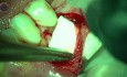Behandlung chronischer Parodontalerkrankungen mit Lasertechnologie