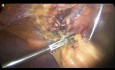 Vorherige obere Bauchchirurgie während einer Laparoskopischen Cholezystektomie