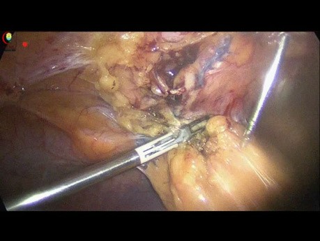 Vorherige obere Bauchchirurgie während einer Laparoskopischen Cholezystektomie