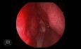 Endoskopische Resektion eines hypophysären Adenoms