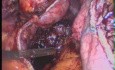 Konversion von vertikaler Gastroplastik zu Sleeve-Gastrektomie