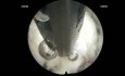 L5 Scheibenextrusion