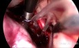 vNotes Hysterektomie