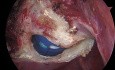 Uterusmyome - totale laparoskopische Hysterektomie