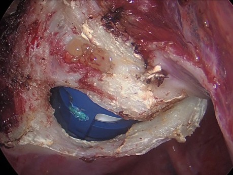 Uterusmyome - totale laparoskopische Hysterektomie