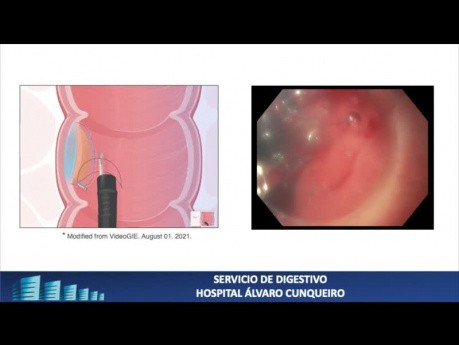 Endoskopische Submukosa-Dissektion (ESD)