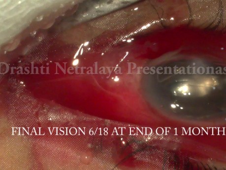 Management der traumatischen Endophthalmitis