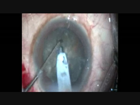 Ereignislose Operation bei harter Katarakt mit Oval Rhexis