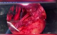 "Rectal Shaving" und Hysterektomie bei Endometriose