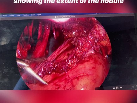 "Rectal Shaving" und Hysterektomie bei Endometriose