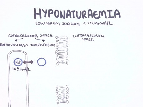 Hyponatriämie - Klassifikation, Ursachen, Pathophysiologie, Behandlung