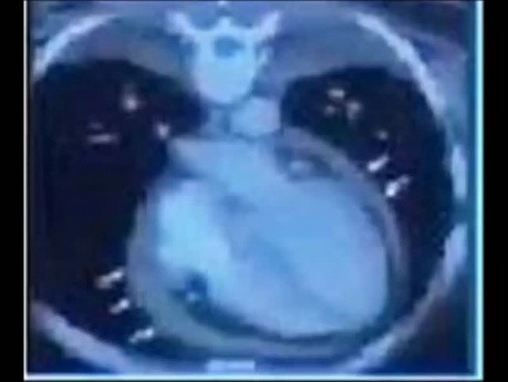 Diagnose, Echokardiographie und Behandlung einer konstriktiven Perikarditis