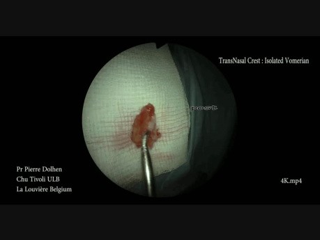 Minimalinvasive endoskopische Septumplastik