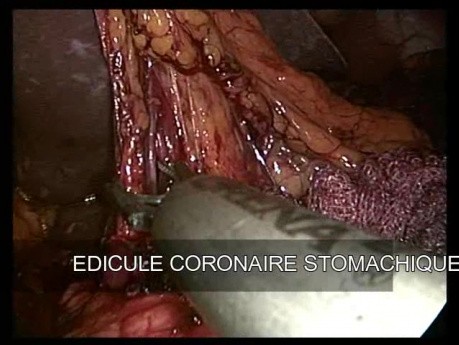 Subtotale Gastrektomie