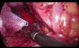 Laparoskopische Durchtrennung des Ligamentum arcuatum medianum - MALS
