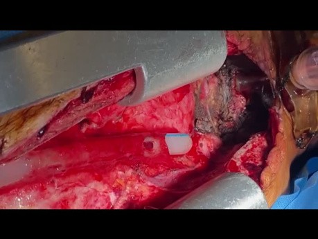 Resektion eines Trachealtumor-Rezidivs an einer früheren Stumpfstelle
