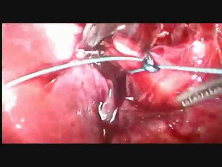 Unterbindung eines kurzen Ductus cysticus