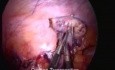 Laparoskopische Ovarialtransposition vor Radiatio