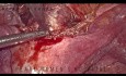 Laparoskopische uterovesikale Fistelreparatur