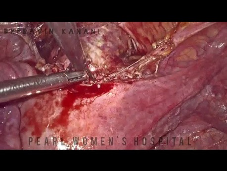 Laparoskopische uterovesikale Fistelreparatur