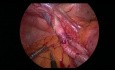 Laparoskopische Behandlung einer eingeklemmten inneren Hernie mit plastischer Chirurgie unter Verwendung des parietalen Peritoneums