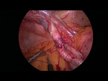 Laparoskopische Behandlung einer eingeklemmten inneren Hernie mit plastischer Chirurgie unter Verwendung des parietalen Peritoneums