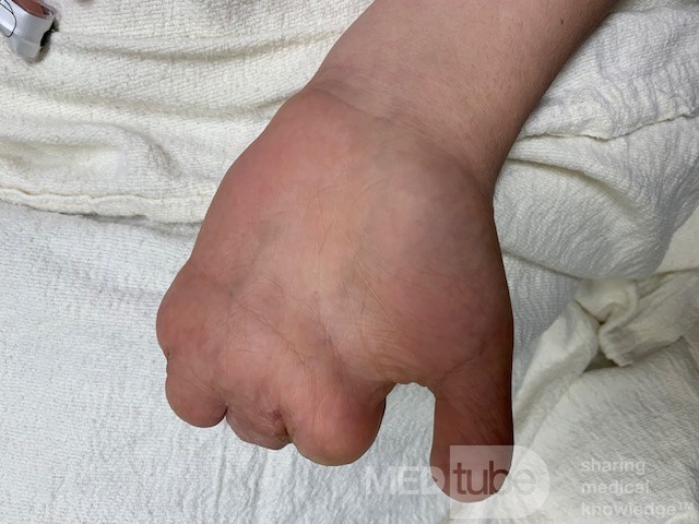 Rekonstruktion einer verbrannten Hand bei einem syrischen Mädchen
