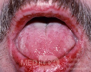Stevens-Johnson-Syndrom (Erythema multiforme)