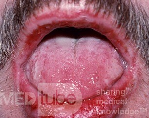 Stevens-Johnson-Syndrom (Erythema multiforme)