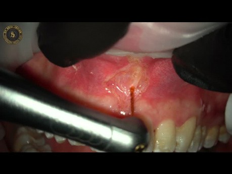Exzision des Oberlippenbändchens mit einem YSGG-Laser