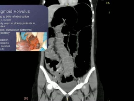 Minimal-invasive Behandlung von  rezidivierender Volvulus des Sigmoids