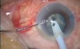 Kataraktchirurgie – Phakoemulsifikation – Stop-and-Chop-Technik