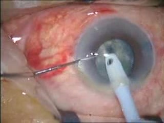 Kataraktchirurgie – Phakoemulsifikation – Stop-and-Chop-Technik