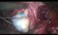Ortung von Myomen während der laparoskopischen Myomektomie