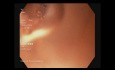 Uretero-Ileostomie