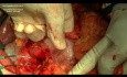 Radikale Gastrektomie und D2  Lymphadenektomie mit Milzerhaltung. 