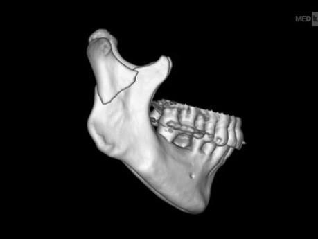 Wie wäre es mit einer zusätzlichen Plattenposition bei der Osteosynthese des Unterkieferkondylus – Podcast