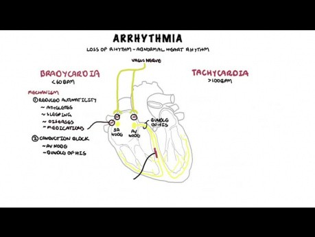 Überblick über Arrhythmie – Mechanismus von Bradyarrhythmie und Tachyarrhythmie