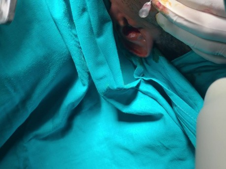 Reduktion des Jochbogens über einem intraoralen Zugang
