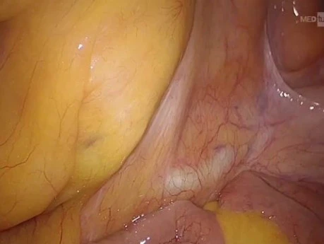 Laparoskopische totale mesorektale Exzision (TME) voluminöser Tumoren beim Mann