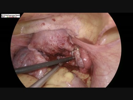 Laparoskopiche Myomektomie- Myome an der hinteren Wand des Uterus (Endometriose) 