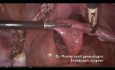 Sakrokolpopexie- das operative Verfahren zur Behandlung des Urogenitalprolaps