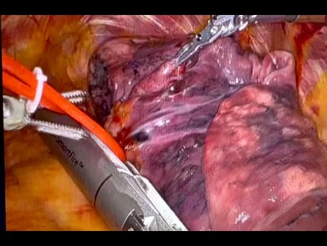 Lobektomie des oberen Teils der linken Lunge mit einem automatischen Hefter