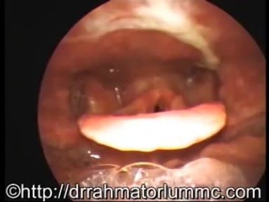 Die Verfolgung der Spuren von Mukus und Eiter bis zu ihrer Quelle bei einer Sinusitis