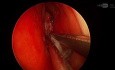 Funktionelle endoskopische Sinuschirurgie - linksseitige Polypen
