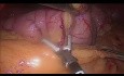 Laparoskopische Sleeve-Gastrektomie